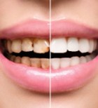 הסרת כתמים מהשיניים - תמונת המחשה